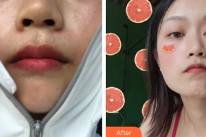 上海藝星醫(yī)療美容醫(yī)院南玉今整形價格表附光子嫩膚案例展示