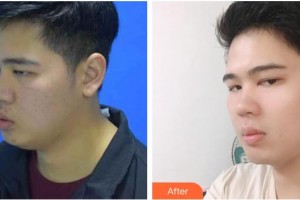 上海富華醫(yī)療美容醫(yī)院候澤民整形價格表附縮脂針案例展示