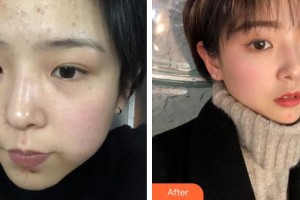 上海富華醫(yī)療美容醫(yī)院宋盈澄整形價格表附點陣激光療程去除痘印痘坑案例展示