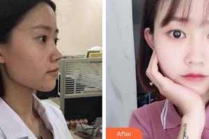 上海港華醫(yī)療美容醫(yī)院陳冰冰整形價格表附嫩膚淡斑微針案例展示