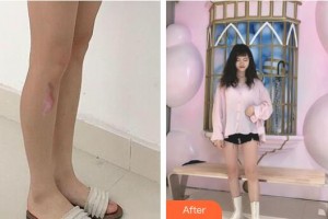 上海港華醫(yī)療美容醫(yī)院周佩整形價(jià)格表附增生疤痕案例展示