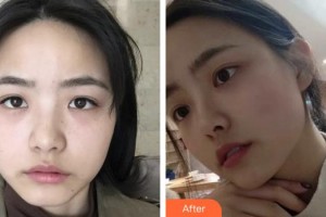 上海港華醫(yī)療美容醫(yī)院季薏整形價(jià)格表附超激光美膚祛雀斑曬斑案例展示