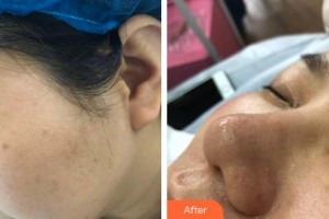 上海瑞麗整形美容醫(yī)院白容官整形價(jià)格表附果酸祛角質(zhì)、黑頭、粉刺雞、皮膚案例展示