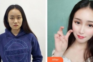 上海比華利整形醫(yī)院李五蘭整形價(jià)格表附韓式切開雙眼皮案例展示