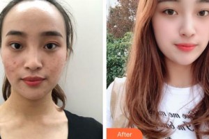 上海比華利整形醫(yī)院陳森 整形價(jià)格表附激光去痘案例展示