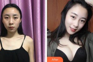 上海愛美醫(yī)療美容門診部童富江整形價(jià)格表附假體隆胸案例展示