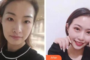 上海瑞麗整形美容醫(yī)院張炫整形價(jià)格表附眼部手術(shù)案例展示