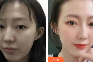 上海吳月蘭整形外科診所侯在恩整形價(jià)格表附眼部手術(shù)案例展示