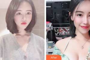 上海美侖醫(yī)療美容門診部于彬整形價(jià)格表附高端假體復(fù)合隆胸案例展示