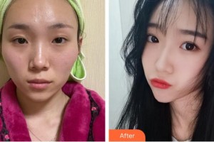 上海韓春民整形外科診所韓春民整形價(jià)格表附顴骨內(nèi)推案例展示