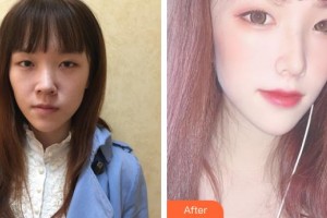 民航上海醫(yī)院整形外科莫建明整形價(jià)格表附美鼻部手術(shù)案例展示