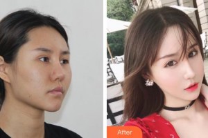 上海博愛(ài)醫(yī)院整形科彭少成整形價(jià)格表附頜面整形案例展示