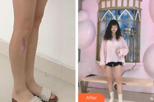 上海交通大學(xué)醫(yī)學(xué)院附屬第三人民醫(yī)院燒傷整形科方勇整形價(jià)格表附增生疤痕案例展示