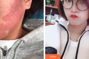 上海新星醫(yī)療美容整形外科楊紅華整形價(jià)格表附點(diǎn)陣祛痘坑痘印案例展示