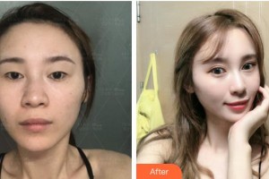 上?，旣愥t(yī)院整形美容中心謝宏德整形價(jià)格表附切開雙眼皮案例展示