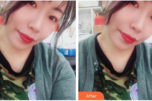 上海新形象整形外科門診部劉岱良整形價(jià)格表附臉頰面部填充案例展示