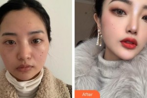 上海瑞麗整形美容醫(yī)院金炳建整形價(jià)格表附光纖溶脂案例展示