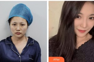 上海新極點(diǎn)醫(yī)療美容診所戴紅整形價(jià)格表附黃金微雕全臉案例展示