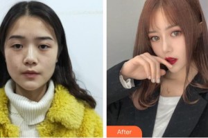 上海復(fù)旦大學(xué)附屬華山醫(yī)院整形外科丁偉整形價(jià)格表附美鼻部手術(shù)案例展示