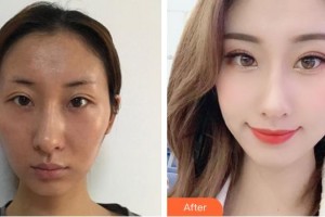 上海市第一人民醫(yī)院整形外科黃一雄整形價(jià)格表附顴骨內(nèi)推案例展示