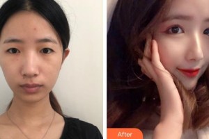 上海第二軍醫(yī)大學(xué)附屬長(zhǎng)征醫(yī)院整形外科章建林整形價(jià)格表附桃花美眼案例展示