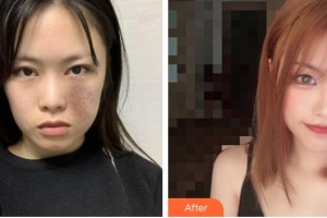 上海宸妃醫(yī)學(xué)美容醫(yī)院徐永成整形價格表附燙傷疤痕案例展示