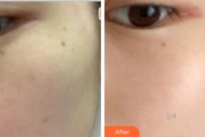 海軍上海保障基地醫(yī)院激光整形美容中心呂丹整形價格表附美白祛斑案例展示