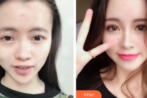 上海伯思立醫(yī)療美容門診部徐曉斐整形價格表附隆鼻案例展示