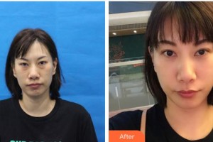 上海鵬愛醫(yī)療美容門診部施秋霞整形價格表附祛眼袋案例展示