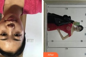 上海伊美爾港華醫(yī)療美容醫(yī)院盧宏整形價格表附點陣激光案例展示