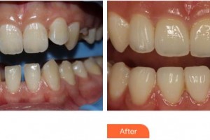 上海伊美爾港華醫(yī)療美容醫(yī)院楚明整形價格表附牙齒矯正案例展示