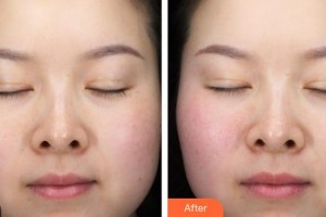 上海柏漫醫(yī)療美容診所趙禹翔整形價格表附面雕下頜緣案例展示