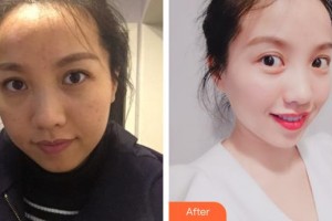 上海薇凱醫(yī)療美容門診部高岱琪整形價(jià)格表附色斑痘印暗黃出油皺紋案例展示