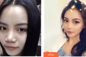 上海文峰醫(yī)療美容門診部楊?；菡蝺r(jià)格表附微針祛痘案例展示