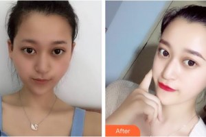 上海解放軍第四五五醫(yī)院激光整形科王曉陽整形價(jià)格表附顴骨降低案例展示