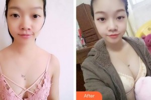 上海保加醫(yī)療美容門診部Tony整形價(jià)格表附濃縮脂肪豐胸案例展示