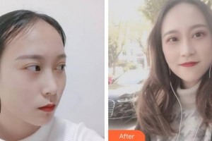 上海解放軍第四五五醫(yī)院激光整形科李宇飛整形價(jià)格表附女性發(fā)際線種植案例展示