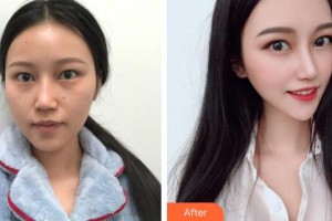 上海時(shí)光整形外科醫(yī)院唐鏖整形價(jià)格表附補(bǔ)水嫩膚抗衰案例展示