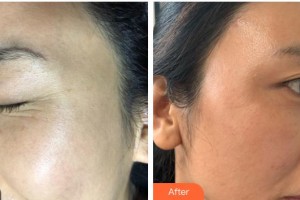 上海文峰醫(yī)療美容門診部潘杰整形價(jià)格表附超激光美膚祛斑案例展示