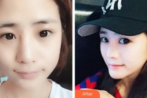 上海詮韓醫(yī)療美容醫(yī)院張杰整形價(jià)格表附小臉針瘦臉案例展示