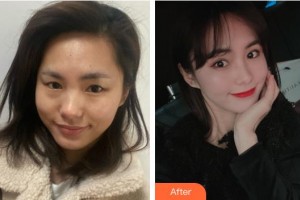 上海俞世放醫(yī)療美容外科診所俞世放整形價(jià)格表附眼部綜合案例展示