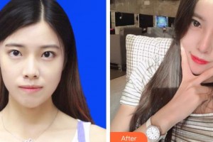 上海時(shí)光整形外科醫(yī)院陶琳整形價(jià)格表附肋軟骨隆鼻案例展示