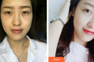 上海時(shí)光整形外科醫(yī)院張曉梅整形價(jià)格表附超激光美膚祛斑案例展示