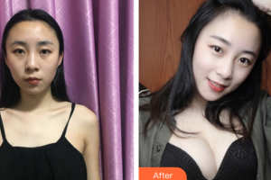 廣州中家醫(yī)家庭醫(yī)生醫(yī)學(xué)整形美容醫(yī)院黃廣香整形價格表附娜琦麗假體隆胸案例展示