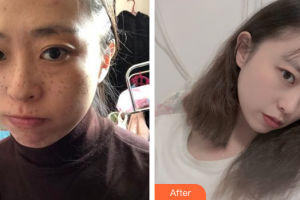 廣州凱美達(dá)整形美容醫(yī)院郭沙雅整形價格表附激光祛斑案例展示