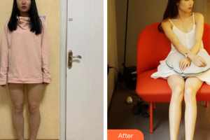 廣州華美醫(yī)療美容醫(yī)院李鐘七整形價格表附吸脂瘦大腿案例展示