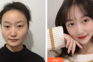 廣州壹加壹美容醫(yī)院鄧艷雯整形價格表附下頜角磨骨案例展示