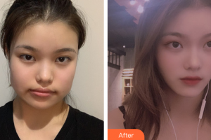 廣州曙光醫(yī)學(xué)美容醫(yī)院張小蕓整形價格表附自然V臉型案例展示