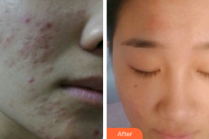 廣州韓妃醫(yī)學(xué)美容醫(yī)院陳坦整形價格表附激光祛痘坑痘印案例展示