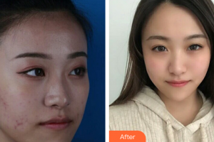 廣州華美醫(yī)療美容醫(yī)院胡艷霞整形價格表附果酸煥膚案例展示